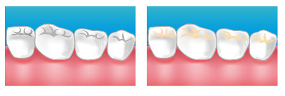 caries dentiste Bois-d'Arcy