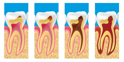 caries dentiste à Bois-d'Arcy